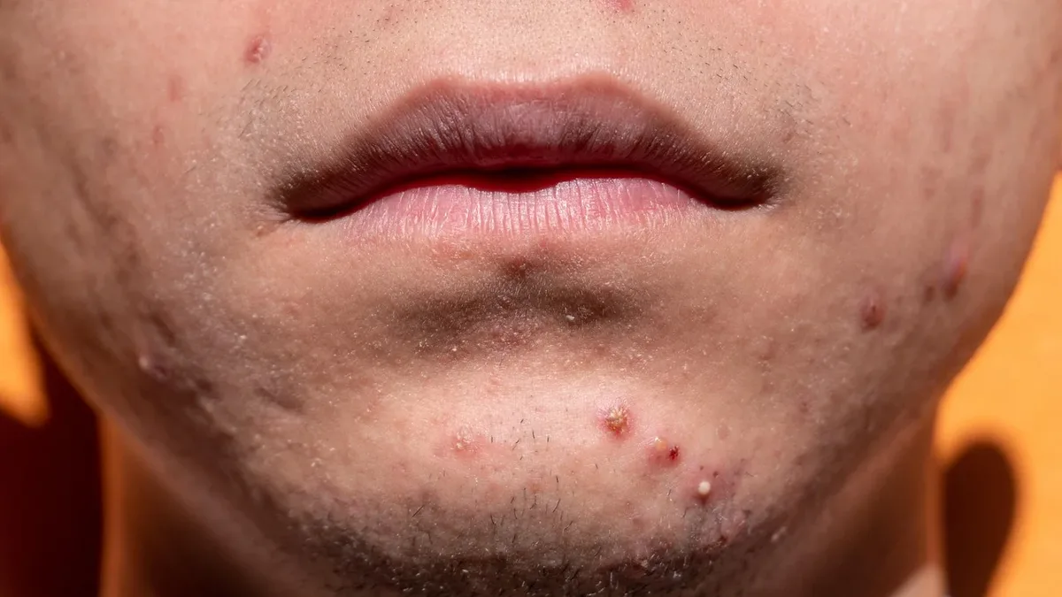 A close-up of a person's mouth and chin, with several small red bumps and whiteheads visible on the skin.